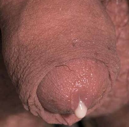 pathological ejaculation when excited